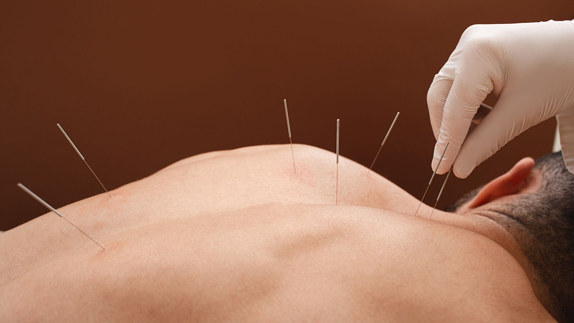 Acupuncture session at Life Medical