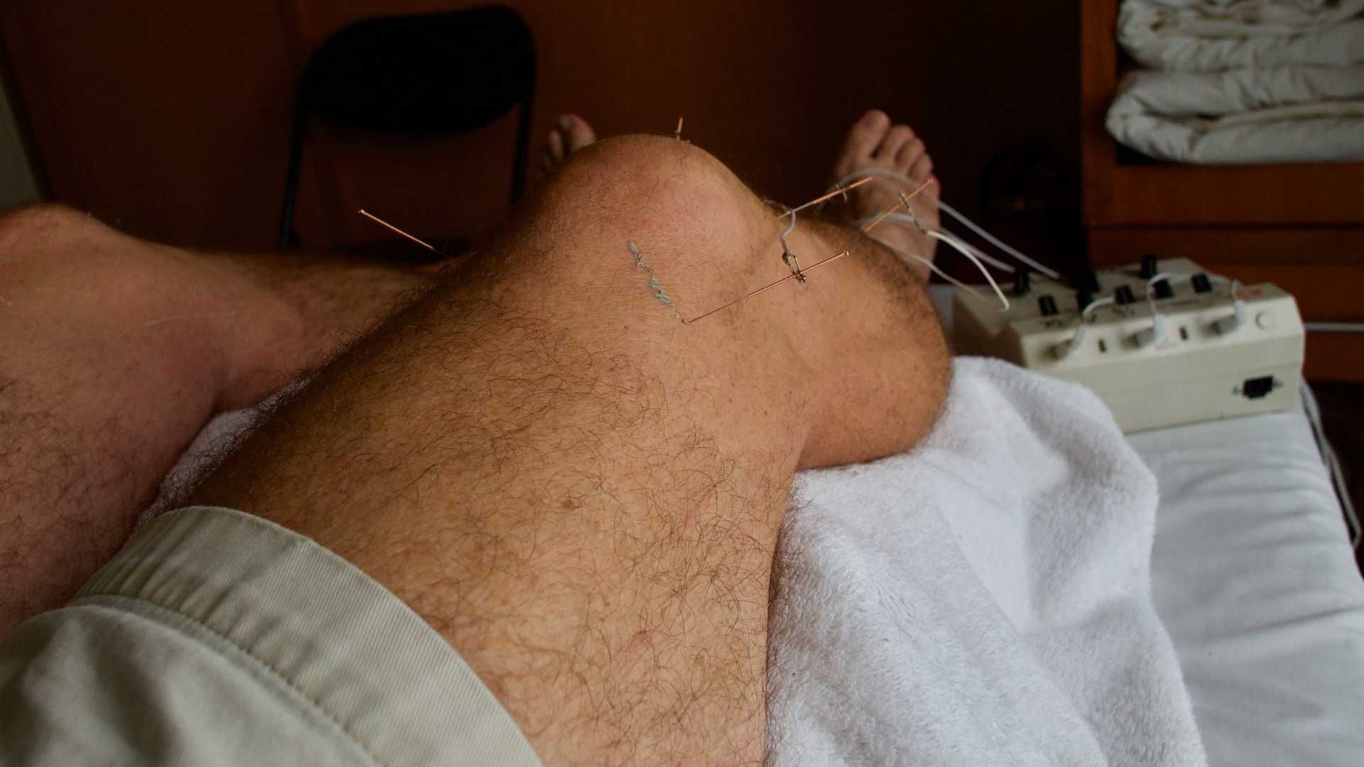Acupuncture needle treatment on leg