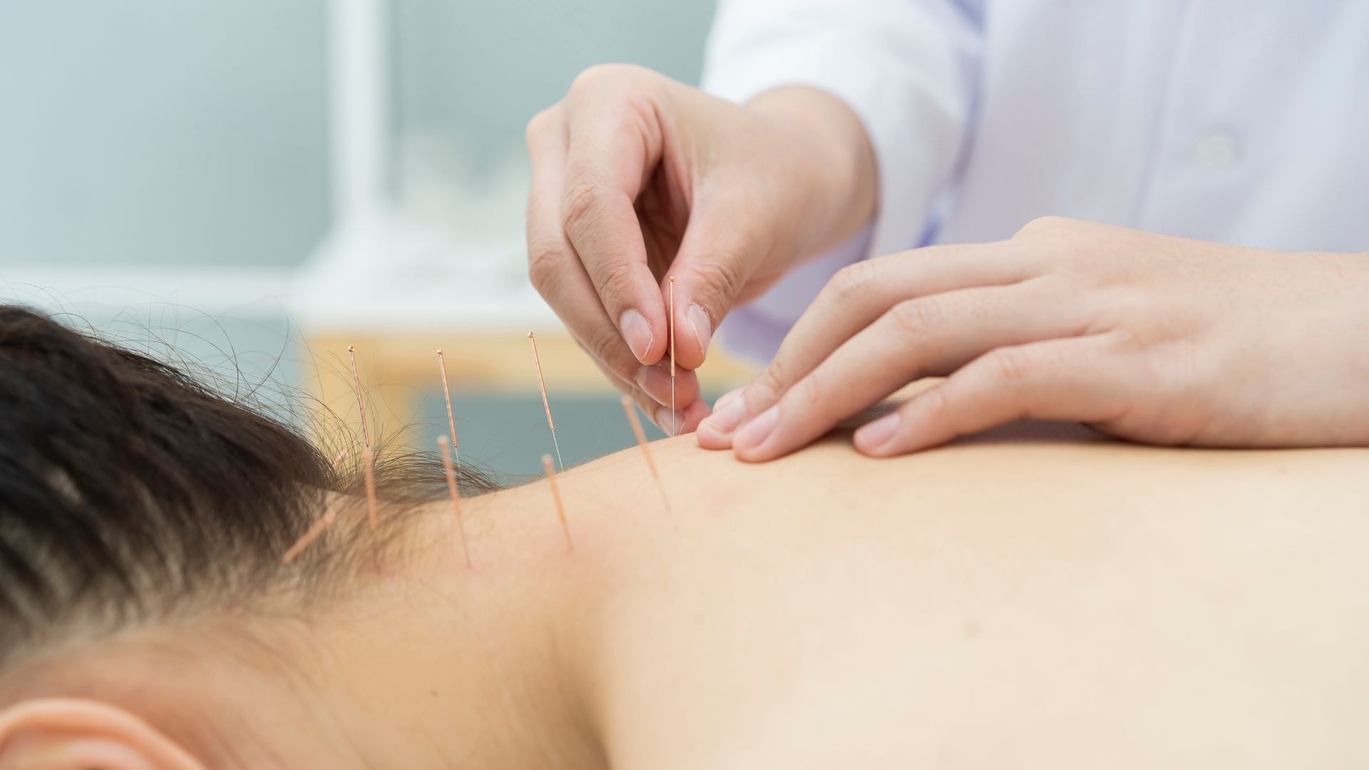 Acupuncture needles close up